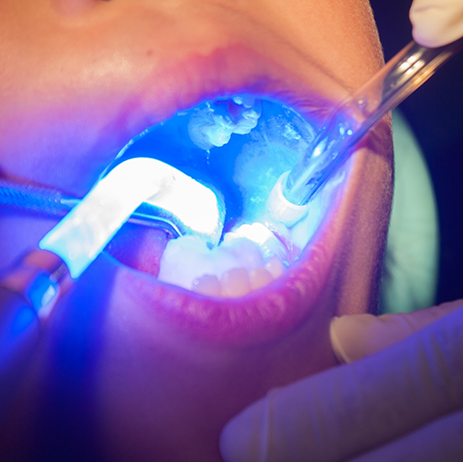 Lights being used to harden dental sealants in place on teeth