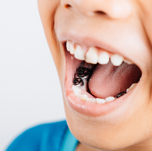 Child with metal crowns holding mouth open