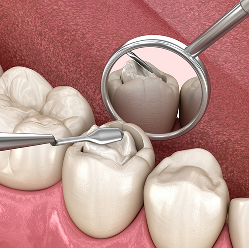 Illustration of tooth during a pulp treatment