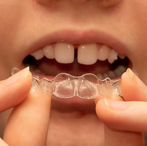 Close up of child with gapped teeth putting in Invisalign