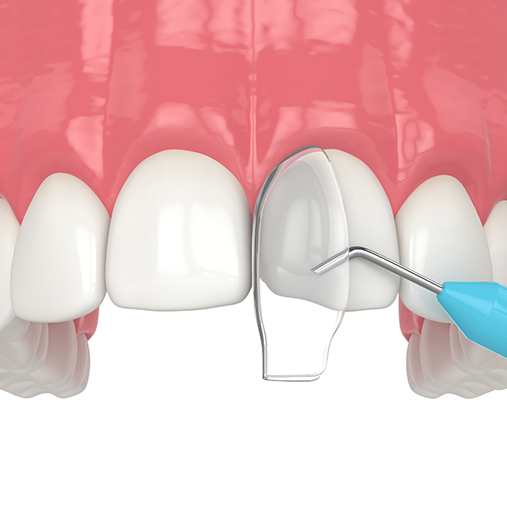 Cosmetic bonding being performed on upper teeth