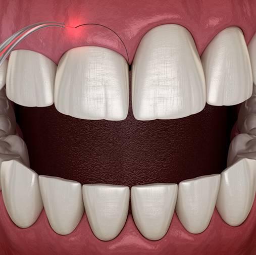 Illustration of laser being used to reshape gums