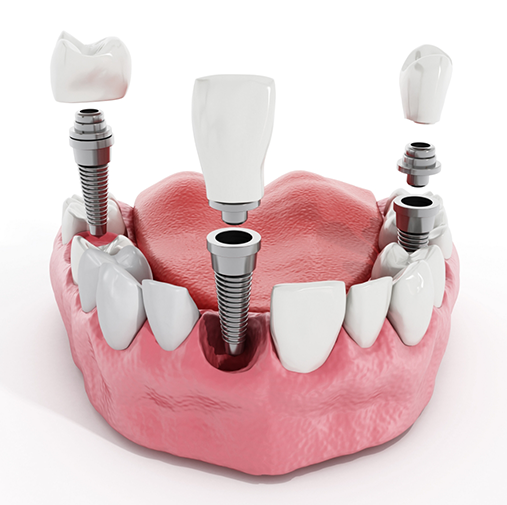 Illustration of dental implants in Bellaire being inserted into jaw