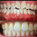 Before and after shots of teeth