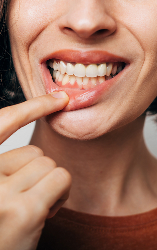 Woman pulling down lip to show gums