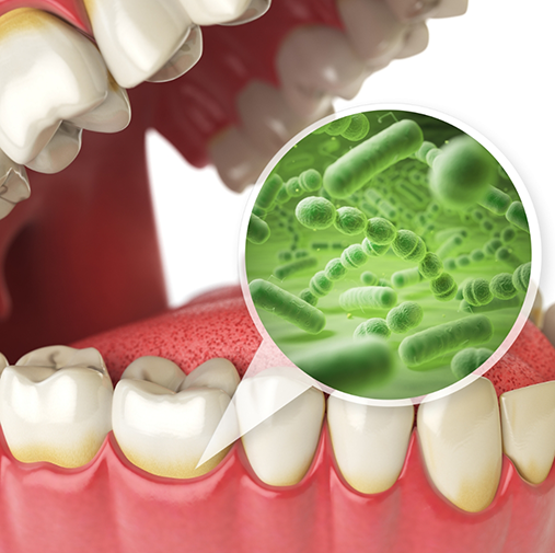 Illustration of bacteria hiding in gums