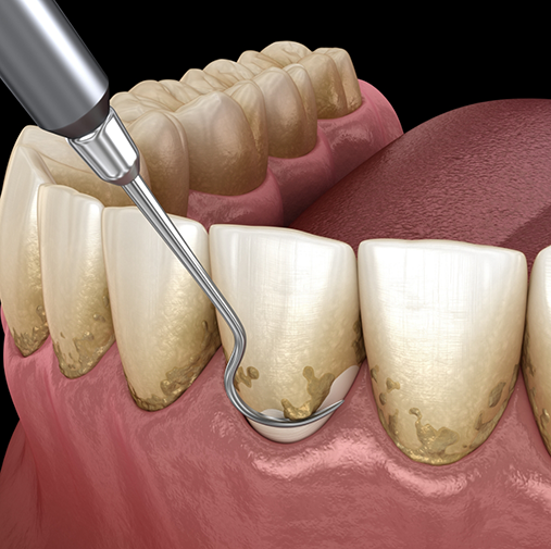 Illustration of scaling and root planing performed for gum disease treatment