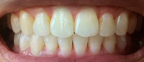 Corrected teeth after dental treatment