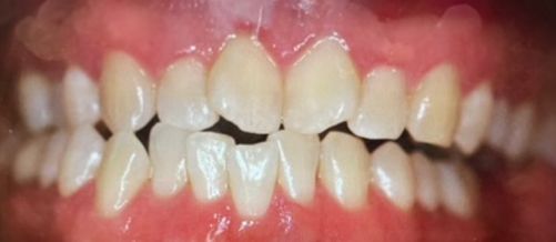 Damaged teeth before dental treatment