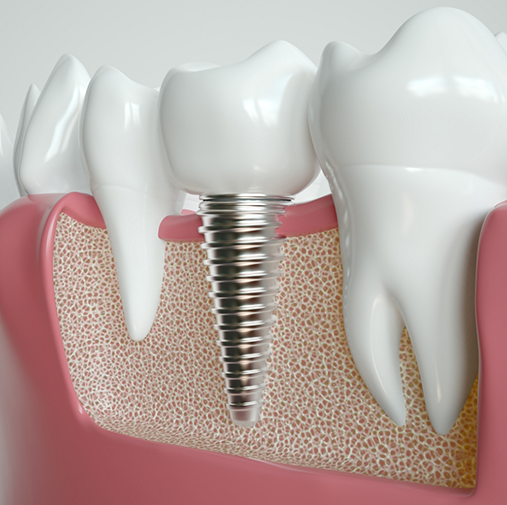 Model of dental implant in jaw between natural teeth