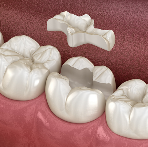 Illustration of an inlay being placed on a tooth