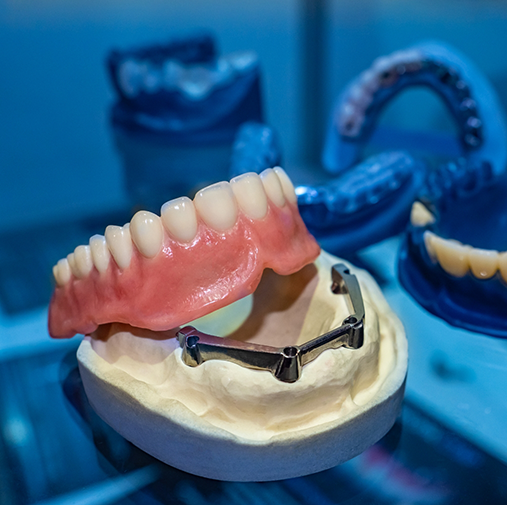 Illustration of a denture and model of dental implants