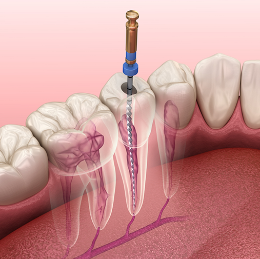 Illustration of root canal treatment in Bellaire