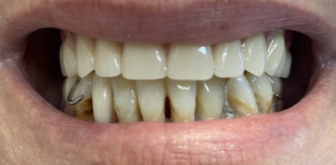 Close up of teeth after treatment