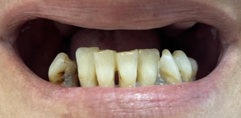 Close up of teeth before treatment