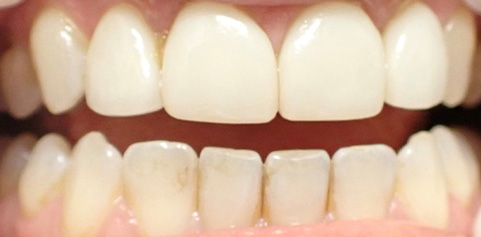 Close up of teeth before treatment