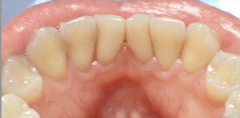 Close up of teeth after treatment