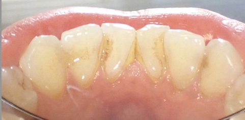 Close up of teeth before treatment