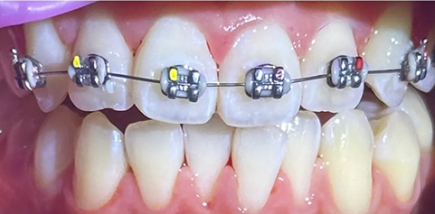 Improved teeth with braces with discoloration removed