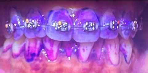 Badly discolored teeth with braces