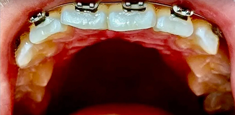 Open mouth with braces after treatment