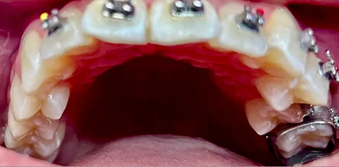 Open mouth with braces before treatment