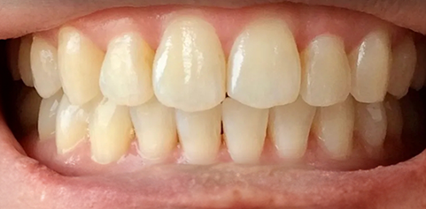 Close up of repaired teeth after treatment