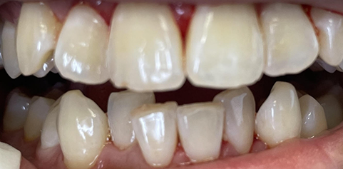 Close up of teeth after treatment