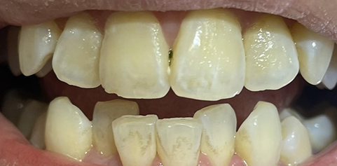 Close up of teeth before treatment