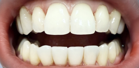 Close up of teeth after treatment