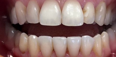 Close up of teeth before treatment