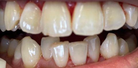 Close up of teeth after treatment