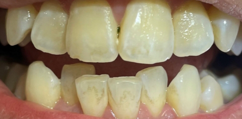 Close up of teeth before treatment