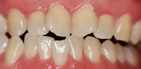 Close up of teeth before treatment