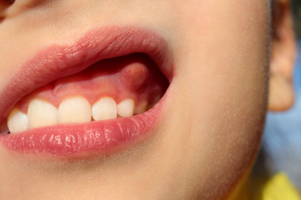 Closeup of a large lump on someone's upper gums